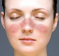 lupus rash